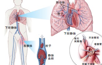 中医王振国—内科诊治：咯血|医院学术交流